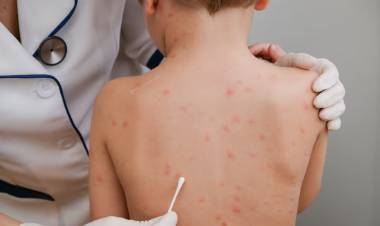 La Provincia alerta por avance de otro brote de sarampión